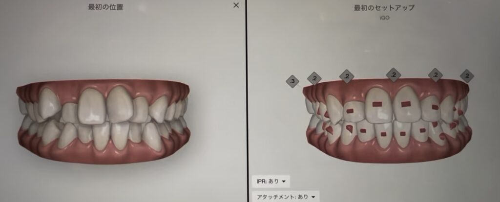 マウスピース矯正のシミュレーション画面