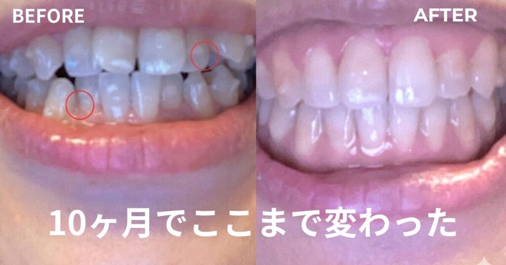 50代の歯並び矯正ビフォーアフター写真