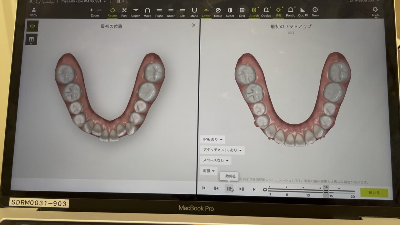 3Dシミュレーション 正面