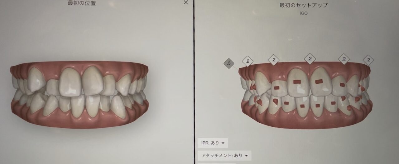 3Dシミュレーション 下顎