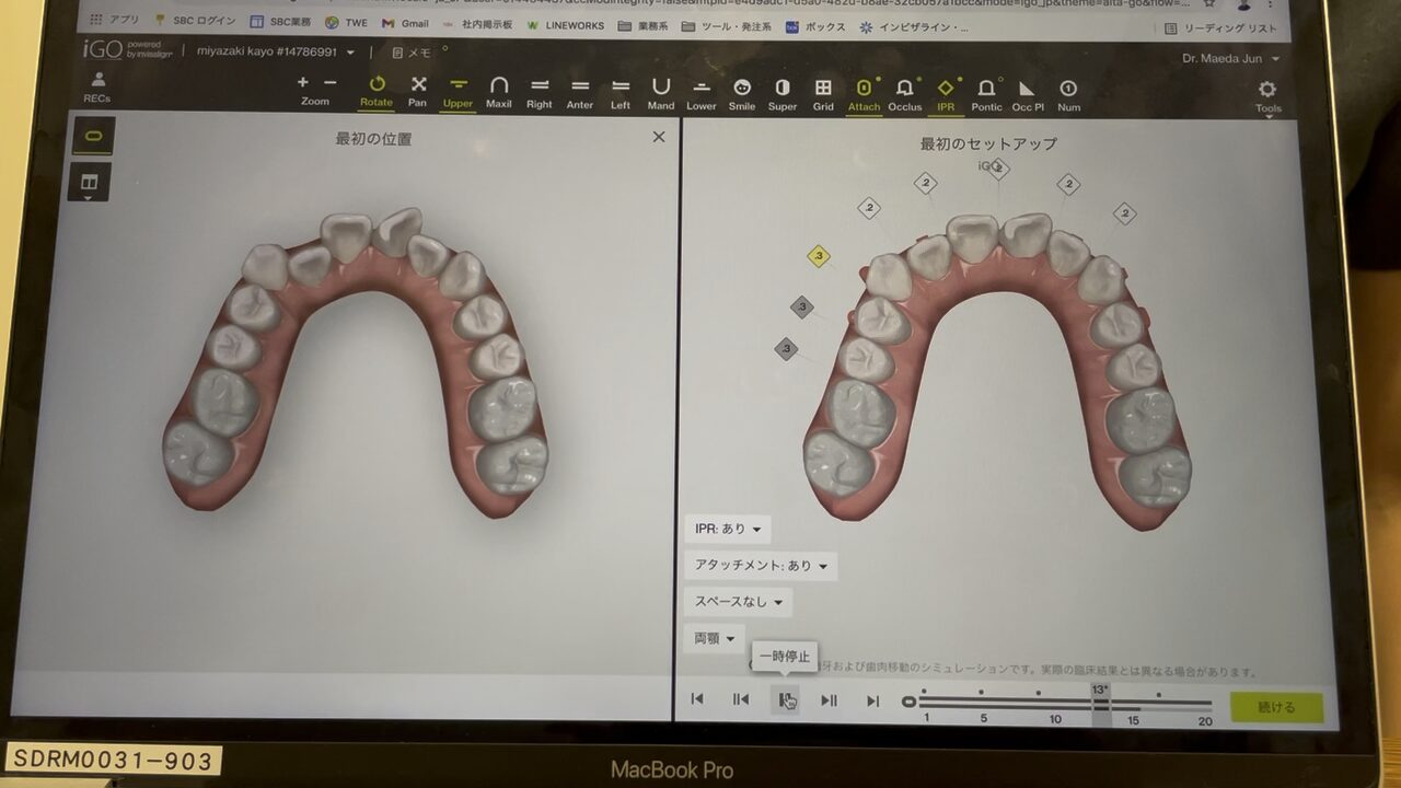 3Dシミュレーション 上顎