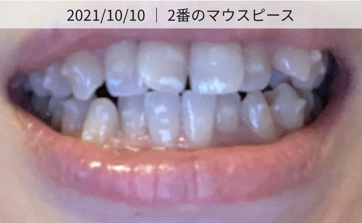 矯正を始めたころの私の歯並び(2021年10月・2枚目のマウスピース)