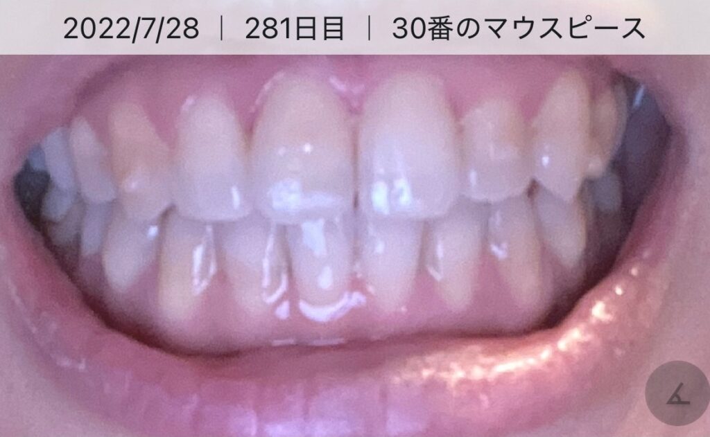 30番のマウスピースのころの凜子の歯並び